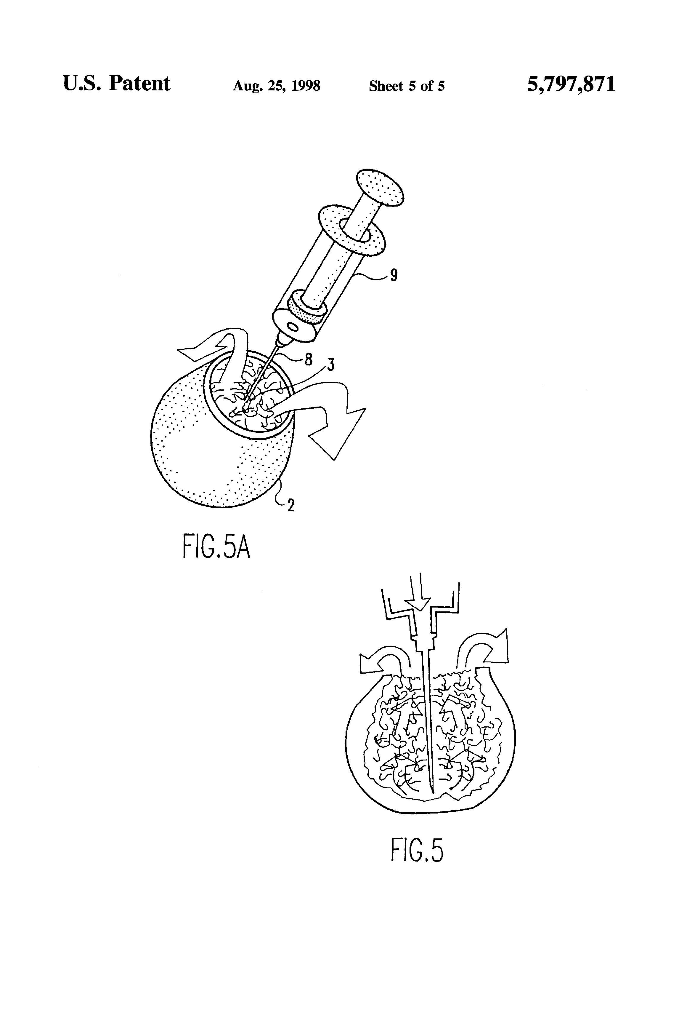 Patent-Illustration-Ultrasonic-Cleaning-Of-Allograft-Bone-_Page_6